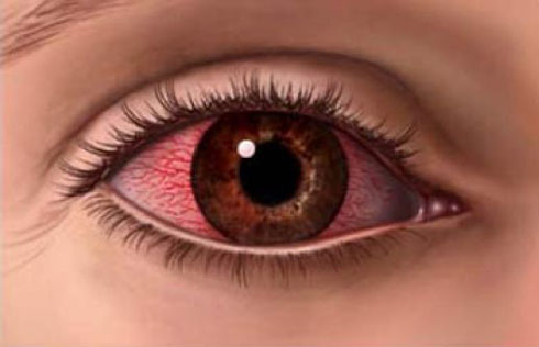 olho-vermelho